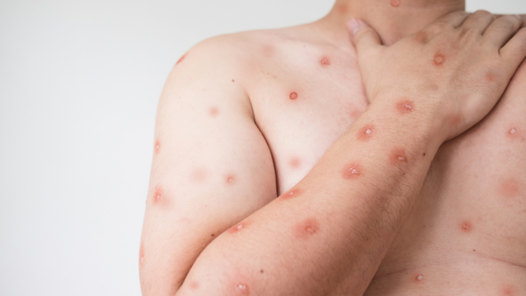 Infectólogo del Hospital de Chillán explica qué es la Mpox y los síntomas a los que se debe prestar atención